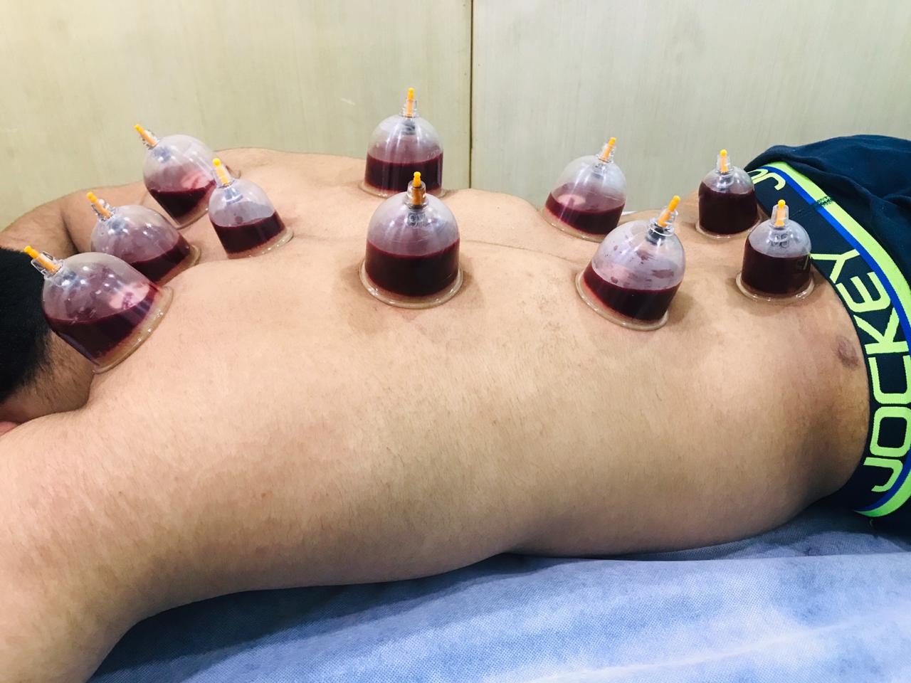 Wet Cupping and its 4 Health Benefits